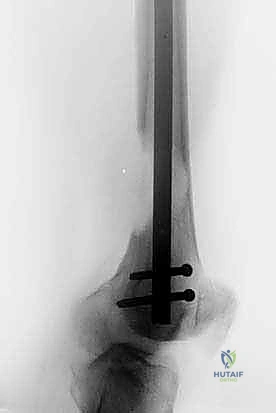 جراحة نقائل العظام الثانوية المتقدمة في اليمن: دليل شامل للمرضى