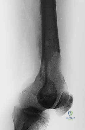 تشريح العظام المصابة بالنقائل