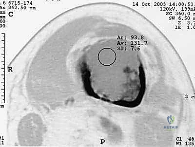 صورة طبية: جراحة نقائل العظام الثانوية المتقدمة في اليمن: دليل شامل للمرضى