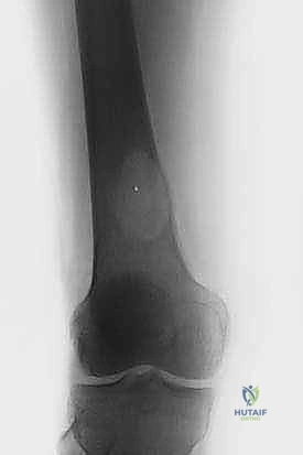 قصص نجاح جراحات العظام