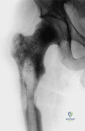 إعادة التأهيل والعلاج الطبيعي