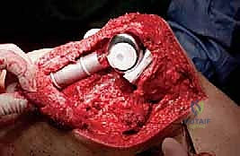 استخدام تقنية المناظير 4K