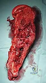 أنواع الأورام المسببة للنقائل