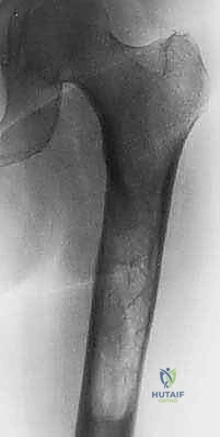 صورة توضيحية لـ جراحة نقائل العظام الثانوية المتقدمة في اليمن: دليل شامل للمرضى