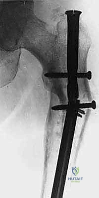 صورة توضيحية لـ جراحة نقائل العظام الثانوية المتقدمة في اليمن: دليل شامل للمرضى