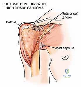 صورة توضيحية لـ جراحة نقائل العظام الثانوية المتقدمة في اليمن: دليل شامل للمرضى