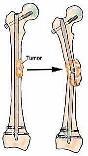 Surgical Masterclass: Advanced Management of Metastatic Bone Disease