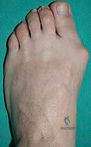 صورة توضيحية لتشوه إبهام القدم الأروح