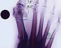 صورة توضيحية لـ تصحيح إبهام القدم الأروح بتقنية SERI طفيفة التوغل في صنعاء دليل شامل للمرضى مع الأستاذ الدكتور محمد هطيف