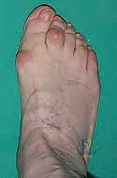 صورة توضيحية لـ تصحيح إبهام القدم الأروح بتقنية SERI طفيفة التوغل في صنعاء دليل شامل للمرضى مع الأستاذ الدكتور محمد هطيف