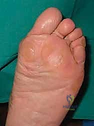 صورة توضيحية لـ تصحيح إبهام القدم الأروح بتقنية SERI طفيفة التوغل في صنعاء دليل شامل للمرضى مع الأستاذ الدكتور محمد هطيف