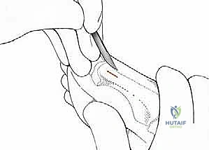 صورة توضيحية لـ تصحيح إبهام القدم الأروح بتقنية SERI طفيفة التوغل في صنعاء دليل شامل للمرضى مع الأستاذ الدكتور محمد هطيف