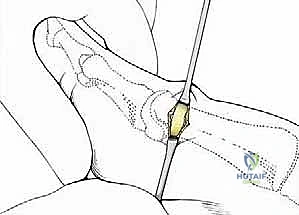 صورة توضيحية لـ تصحيح إبهام القدم الأروح بتقنية SERI طفيفة التوغل في صنعاء دليل شامل للمرضى مع الأستاذ الدكتور محمد هطيف