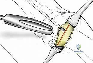 صورة طبية: تصحيح إبهام القدم الأروح بتقنية SERI طفيفة التوغل في صنعاء دليل شامل للمرضى مع الأستاذ الدكتور محمد هطيف