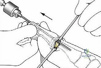 صورة توضيحية لـ تصحيح إبهام القدم الأروح بتقنية SERI طفيفة التوغل في صنعاء دليل شامل للمرضى مع الأستاذ الدكتور محمد هطيف