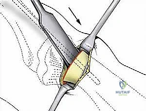 صورة طبية: تصحيح إبهام القدم الأروح بتقنية SERI طفيفة التوغل في صنعاء دليل شامل للمرضى مع الأستاذ الدكتور محمد هطيف