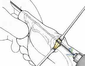 صورة توضيحية لـ تصحيح إبهام القدم الأروح بتقنية SERI طفيفة التوغل في صنعاء دليل شامل للمرضى مع الأستاذ الدكتور محمد هطيف