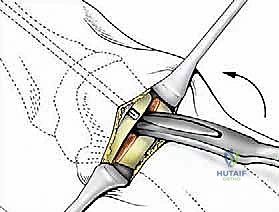 صورة توضيحية لـ تصحيح إبهام القدم الأروح بتقنية SERI طفيفة التوغل في صنعاء دليل شامل للمرضى مع الأستاذ الدكتور محمد هطيف