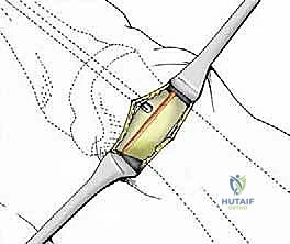 صورة توضيحية لـ تصحيح إبهام القدم الأروح بتقنية SERI طفيفة التوغل في صنعاء دليل شامل للمرضى مع الأستاذ الدكتور محمد هطيف