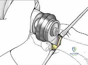 صورة توضيحية لـ تصحيح إبهام القدم الأروح بتقنية SERI طفيفة التوغل في صنعاء دليل شامل للمرضى مع الأستاذ الدكتور محمد هطيف