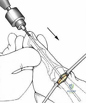 صورة توضيحية لـ تصحيح إبهام القدم الأروح بتقنية SERI طفيفة التوغل في صنعاء دليل شامل للمرضى مع الأستاذ الدكتور محمد هطيف