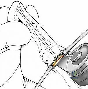 صورة طبية: تصحيح إبهام القدم الأروح بتقنية SERI طفيفة التوغل في صنعاء دليل شامل للمرضى مع الأستاذ الدكتور محمد هطيف