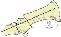 صورة طبية: تصحيح إبهام القدم الأروح بتقنية SERI طفيفة التوغل في صنعاء دليل شامل للمرضى مع الأستاذ الدكتور محمد هطيف