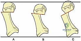 تصحيح إبهام القدم الأروح بتقنية SERI طفيفة التوغل في صنعاء دليل شامل للمرضى مع الأستاذ الدكتور محمد هطيف