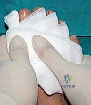 صورة طبية: تصحيح إبهام القدم الأروح بتقنية SERI طفيفة التوغل في صنعاء دليل شامل للمرضى مع الأستاذ الدكتور محمد هطيف