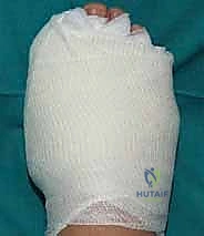 صورة طبية: تصحيح إبهام القدم الأروح بتقنية SERI طفيفة التوغل في صنعاء دليل شامل للمرضى مع الأستاذ الدكتور محمد هطيف