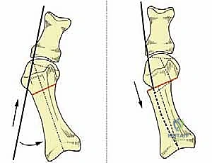 صورة توضيحية لـ تصحيح إبهام القدم الأروح بتقنية SERI طفيفة التوغل في صنعاء دليل شامل للمرضى مع الأستاذ الدكتور محمد هطيف