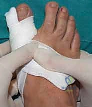 صورة توضيحية لـ تصحيح إبهام القدم الأروح بتقنية SERI طفيفة التوغل في صنعاء دليل شامل للمرضى مع الأستاذ الدكتور محمد هطيف