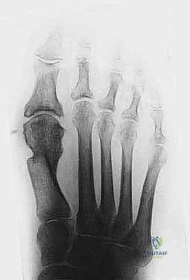 Illustration of hallux valgus correction - Dr. Mohammed Hutaif