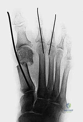 صورة طبية: تصحيح إبهام القدم الأروح بتقنية SERI طفيفة التوغل في صنعاء دليل شامل للمرضى مع الأستاذ الدكتور محمد هطيف