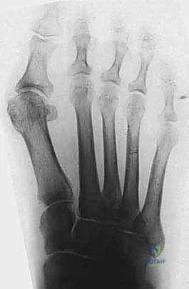 صورة توضيحية لـ تصحيح إبهام القدم الأروح بتقنية SERI طفيفة التوغل في صنعاء دليل شامل للمرضى مع الأستاذ الدكتور محمد هطيف