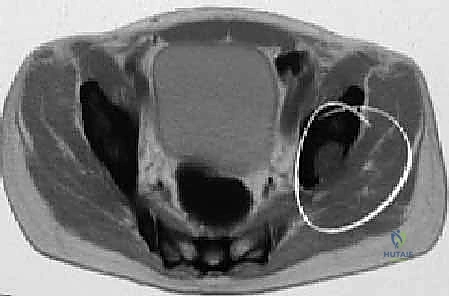 الشق الجراحي والوصول للمفصل