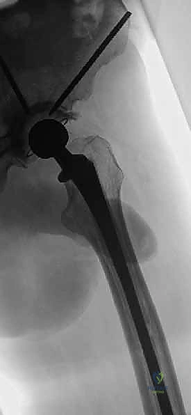 التخطيط الجراحي واختيار المفصل