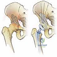العلاج الطبيعي والمشي المبكر