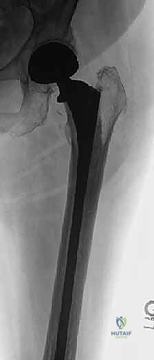 صورة توضيحية لـ استبدال مفصل الورك الكلي لآفات السرطان النقيلي: دليل شامل للمرضى في اليمن