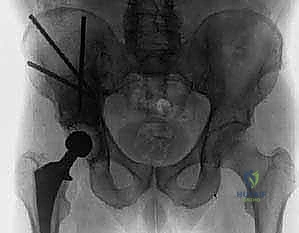 تمارين إعادة التأهيل المنزلي