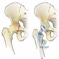 صورة توضيحية لـ استبدال مفصل الورك الكلي لآفات السرطان النقيلي