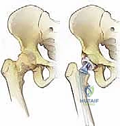 تأثير الأورام على رأس وعنق الفخذ