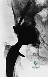 استئصال العظم المتضرر