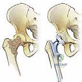 أنواع الآفات النقيليّة في الأشعة