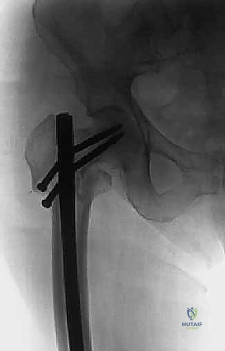 صورة توضيحية لـ استبدال مفصل الورك الكلي لآفات السرطان النقيلي: دليل شامل للمرضى في اليمن