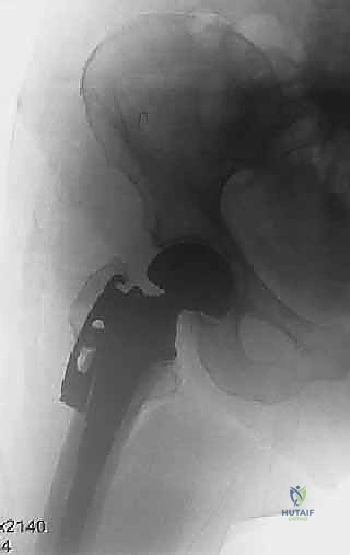 التشريح الهيكلي لمفصل الورك