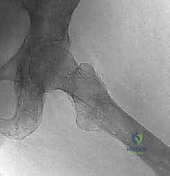 تثبيت الجذع الفخذي