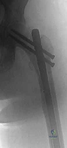 اختبار استقرار المفصل