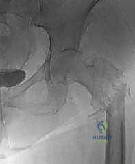 تأثير الأورام على نخاع العظم