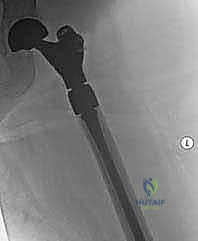 استبدال مفصل الورك الكلي لآفات السرطان النقيلي: دليل شامل للمرضى في اليمن